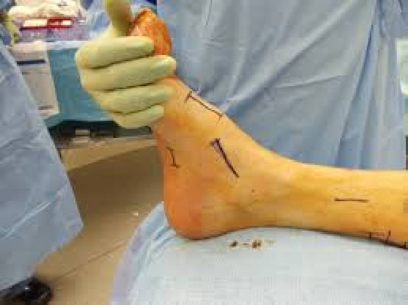 foot surgery