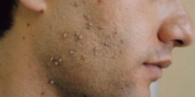 शरीर पर होने वाले मस्सों को इस प्रकार करे दूर, अपनाए ये घरेलू नूस्के