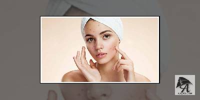 झाइयों को कम करने के घरेलू नुस्खे